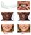Snapon smile is the new whitening denture that simulates the denture