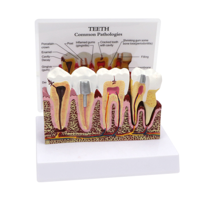 Tooth model