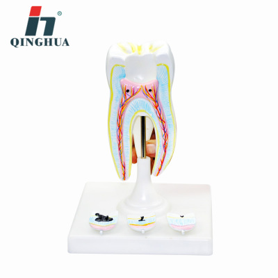 Qinghua QH3353-5 Molars with Tooth Decay Model Human Teeth Anatomy Teaching Biomedical Demonstration