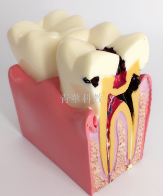 Dental model 6 times dental caries contrast model