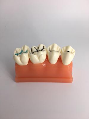 Oral model Dentistry Doctor - patient communication model Dental model 3 - fold fissure closure model